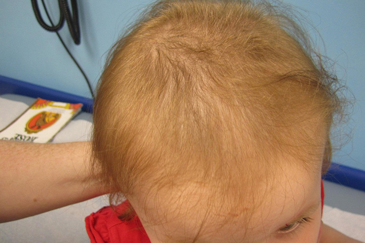 تلوژن افلوویوم در کودکان